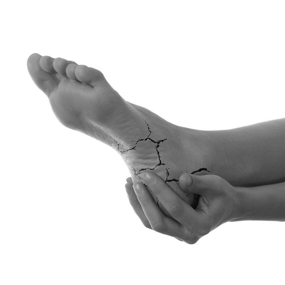 Dry Cracked Heels Derbyshire