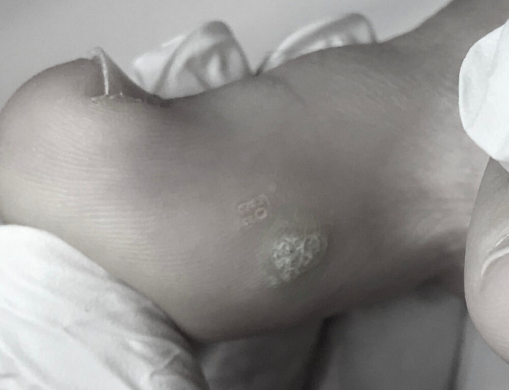 Curly Toes?… [Adductovarus Deformity of the 4th or 5th Toe] – Care For Feet