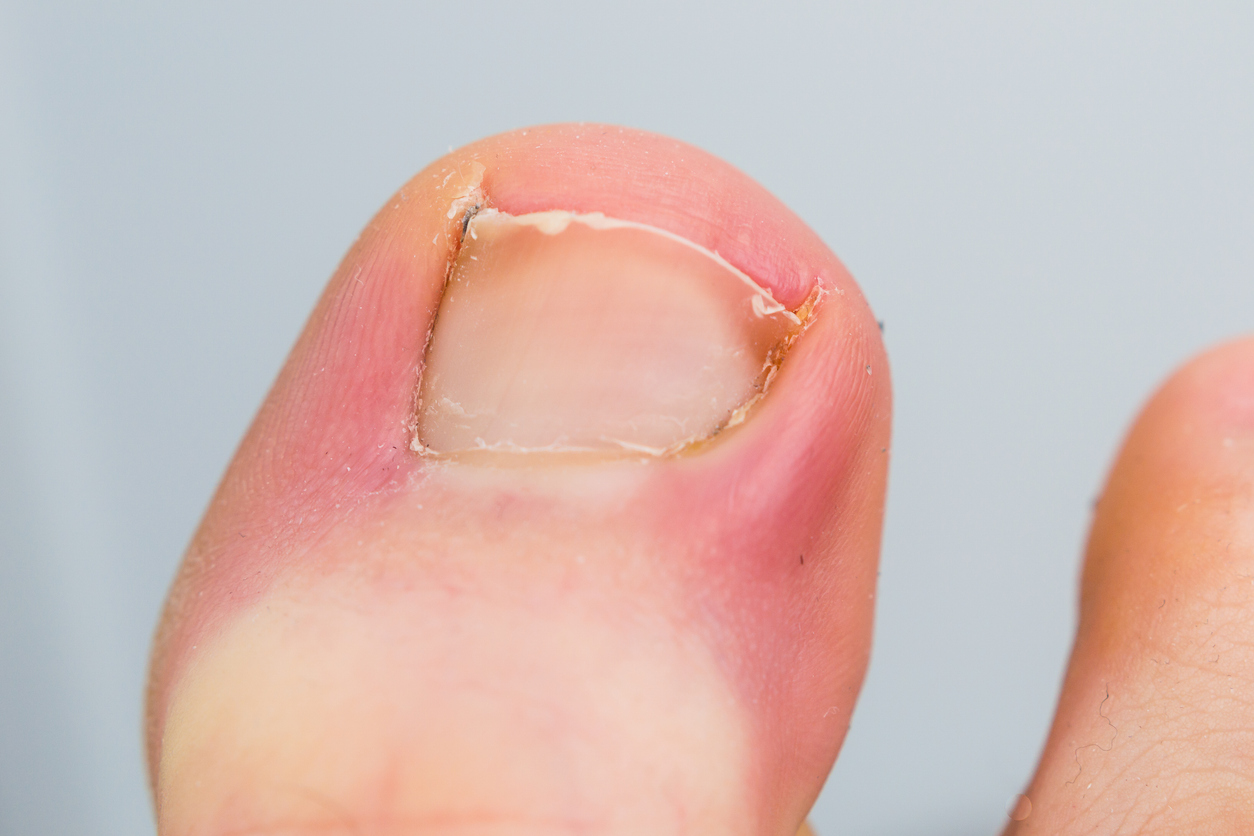 Nail Surgery and Curing an Ingrown Toenail in the High Peak and Derbyshire  Dales – Care For Feet